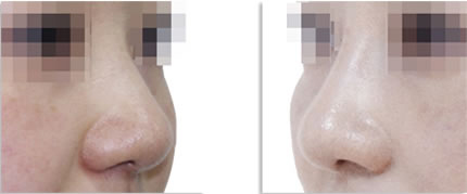 不同风格的鼻子,不同鼻型的矫正方法