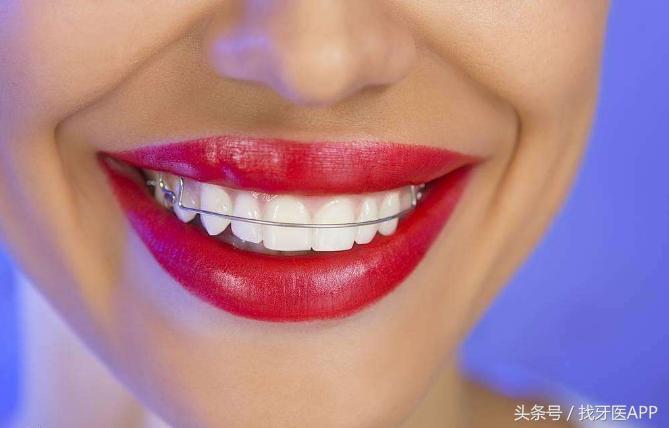 牙齿矫正能不能只矫正一半的牙齿，矫正牙齿能不能只做半口