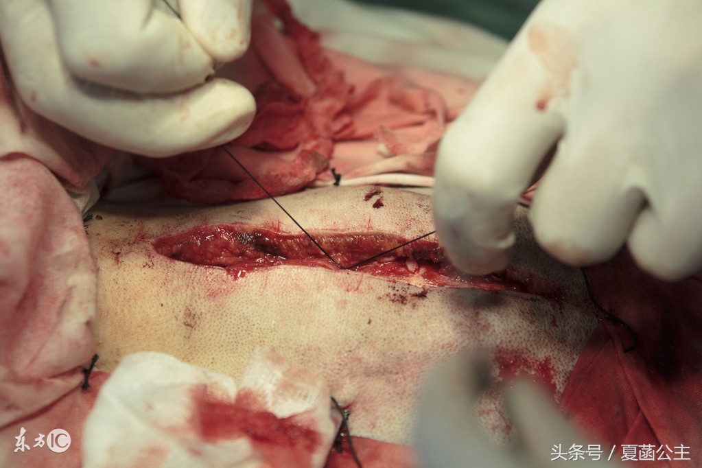 媳妇剖腹产24天突然恶露很多,剖腹产伤口30天有血