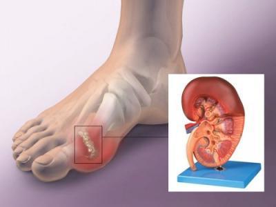 痛风的人应该怎么吃,痛风的人应该多吃什么