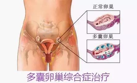 为什么50%的不孕女性这里会长毛？