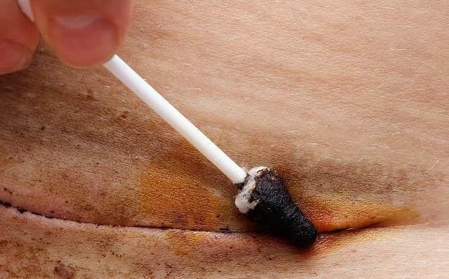 怀孕期间剖腹产伤口痒是怎么回事,剖宫产怀孕后伤口刺痛怎么办