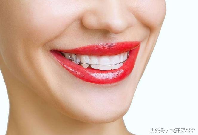 牙齿矫正能不能只矫正一半的牙齿，矫正牙齿能不能只做半口