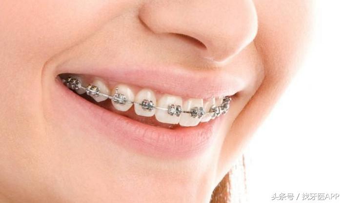 牙齿矫正能不能只矫正一半的牙齿，矫正牙齿能不能只做半口