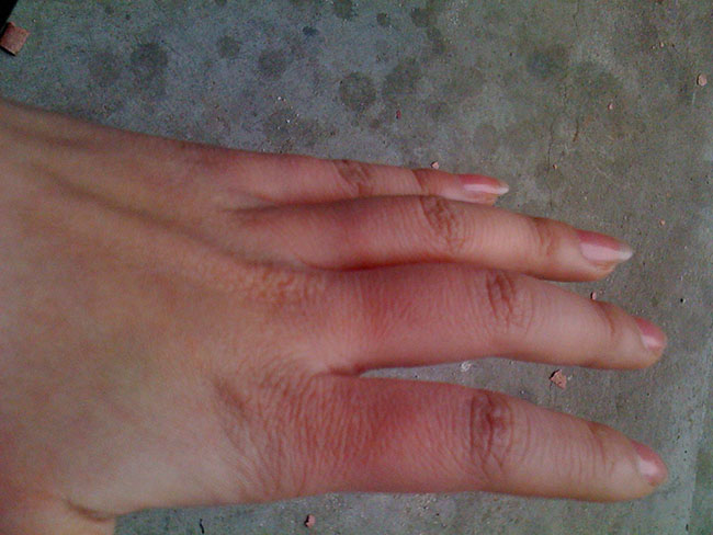 手被开水烫怎么快速解决,手被开水烫着了怎么处理