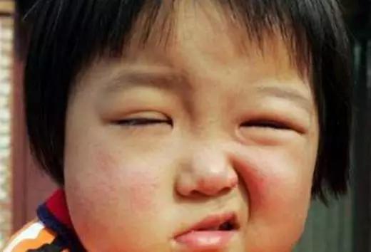 3岁女儿被妈妈一巴掌打成面瘫，医生说这得治一个多月