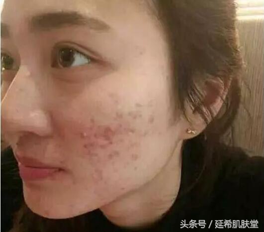 换季长痘是什么原因怎么处理,一到换季就长痘怎么回事