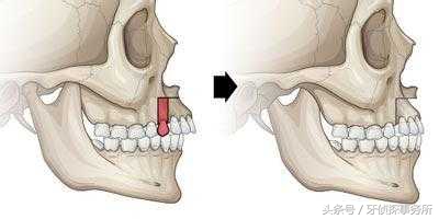 拔牙可以瘦脸轮廓吗,拔牙真的可以瘦脸吗