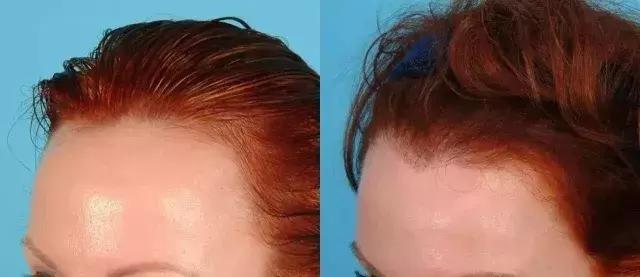 发际线不好看怎么剪,如何拯救90后的发际线