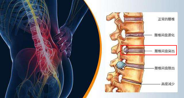 腰腿疼下肢麻木怎么治,腰椎间盘突出腰腿痛麻木怎么治疗