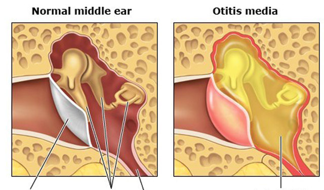 小儿中耳炎的症状和治疗方法,中耳炎患者如何护理中耳炎