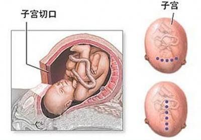 剖腹产麻醉针眼疼痛,剖腹产的时候打的麻醉痛不