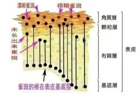 突然长斑怎么办,长斑穴位堵了