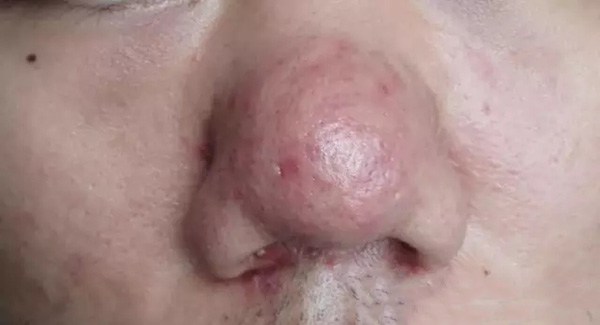 怎样分辨酒渣鼻,酒渣鼻严重怎么治疗