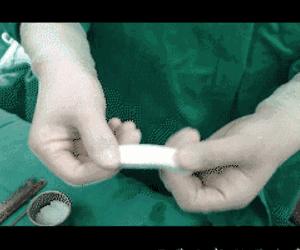 比超声刀更好的治疗方法,膨体隆鼻一年后鼻尖有个痘