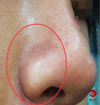鼻翼两侧脏脏的,为什么鼻翼总是卡粉