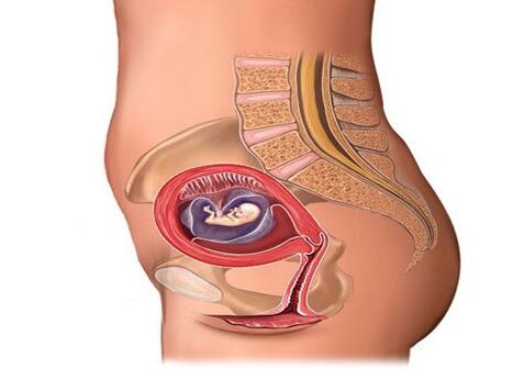 孕期尿床别忽视,产前尿失禁怎么回事