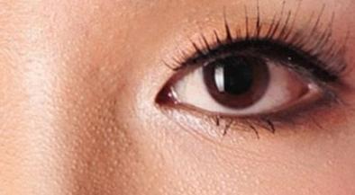 毛孔有脂肪粒什么原因,毛孔里有白色的东西是什么