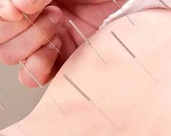 针灸怎么样治疗疾病的,针灸如何快速上手
