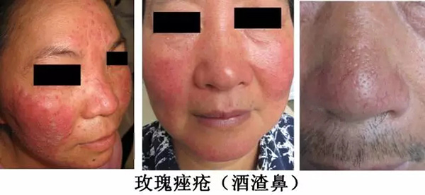 怎样分辨酒渣鼻,酒渣鼻严重怎么治疗