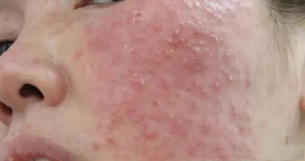 怎样分辨酒渣鼻,酒渣鼻严重怎么治疗