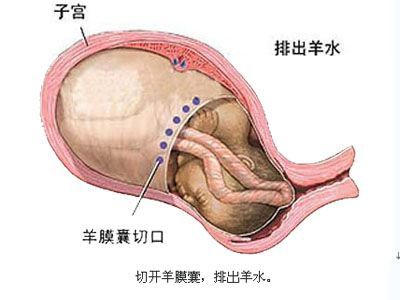 剖腹产麻醉针眼疼痛,剖腹产的时候打的麻醉痛不