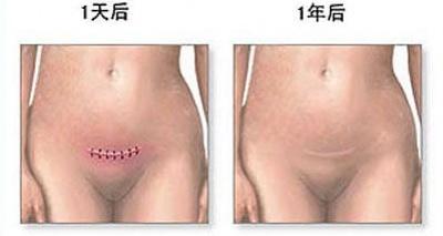 剖腹产麻醉针眼疼痛,剖腹产的时候打的麻醉痛不