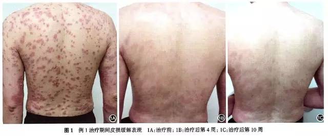 银屑病生物制剂可善挺要打多少针,银屑病生物制剂的效果如何