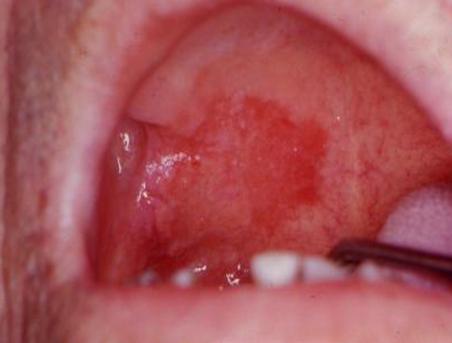 陈忠实为什么会得舌癌,陈忠实的舌癌做了什么治疗