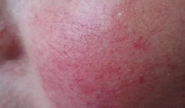 怎样分辨酒渣鼻,酒渣鼻严重怎么治疗