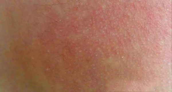 怎样分辨酒渣鼻,酒渣鼻严重怎么治疗