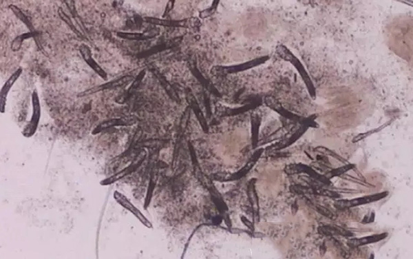 怎样分辨酒渣鼻,酒渣鼻严重怎么治疗