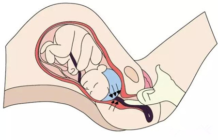 孕期尿床别忽视,产前尿失禁怎么回事