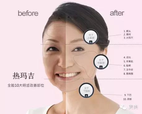 比超声刀更好的治疗方法,膨体隆鼻一年后鼻尖有个痘