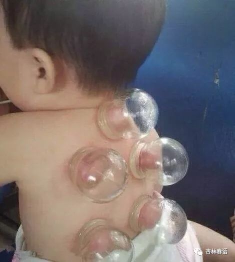 「杏林微科普」儿童感冒高发中医药综合疗法有效改善症状还不损伤抵抗力