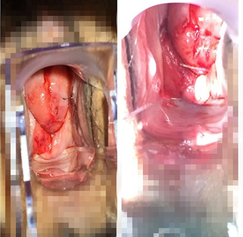 leep术是什么,leep术用打麻药吗