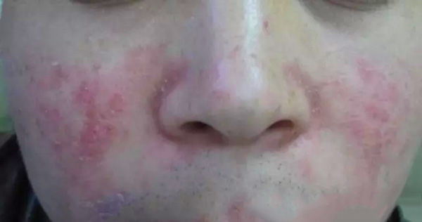 怎样分辨酒渣鼻,酒渣鼻严重怎么治疗