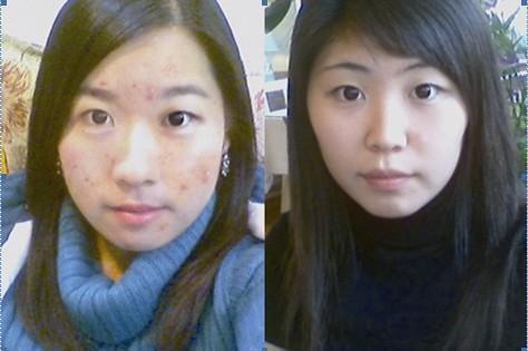 成人痘和青春痘的区别,有痘痘的人要怎么治