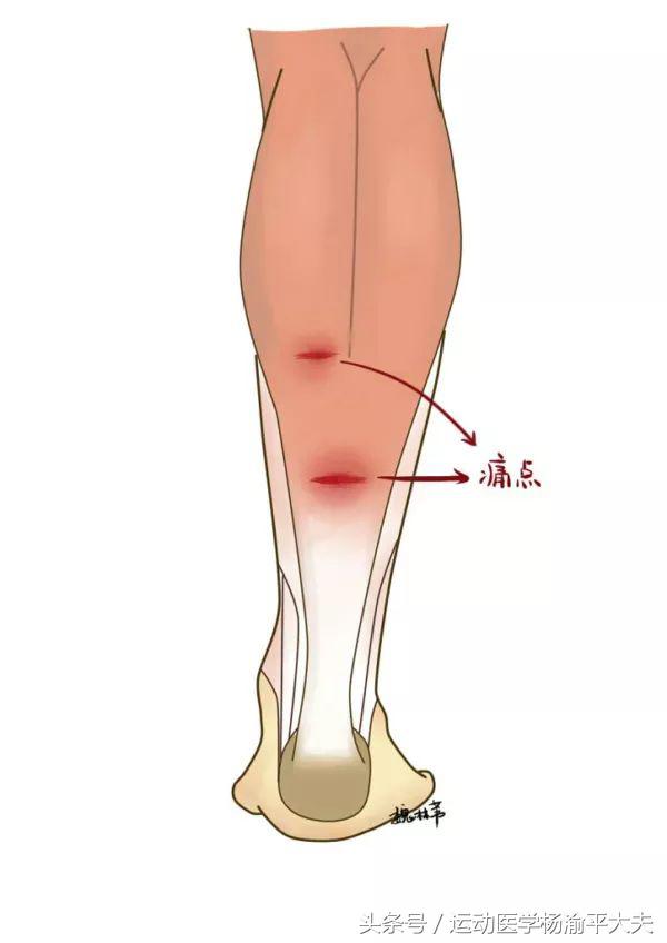 听说过什么是网球腿吗?