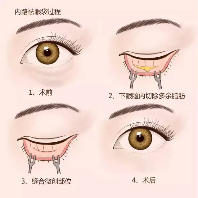 眼袋显老还是泪沟显老,40岁眼袋有泪沟怎么办
