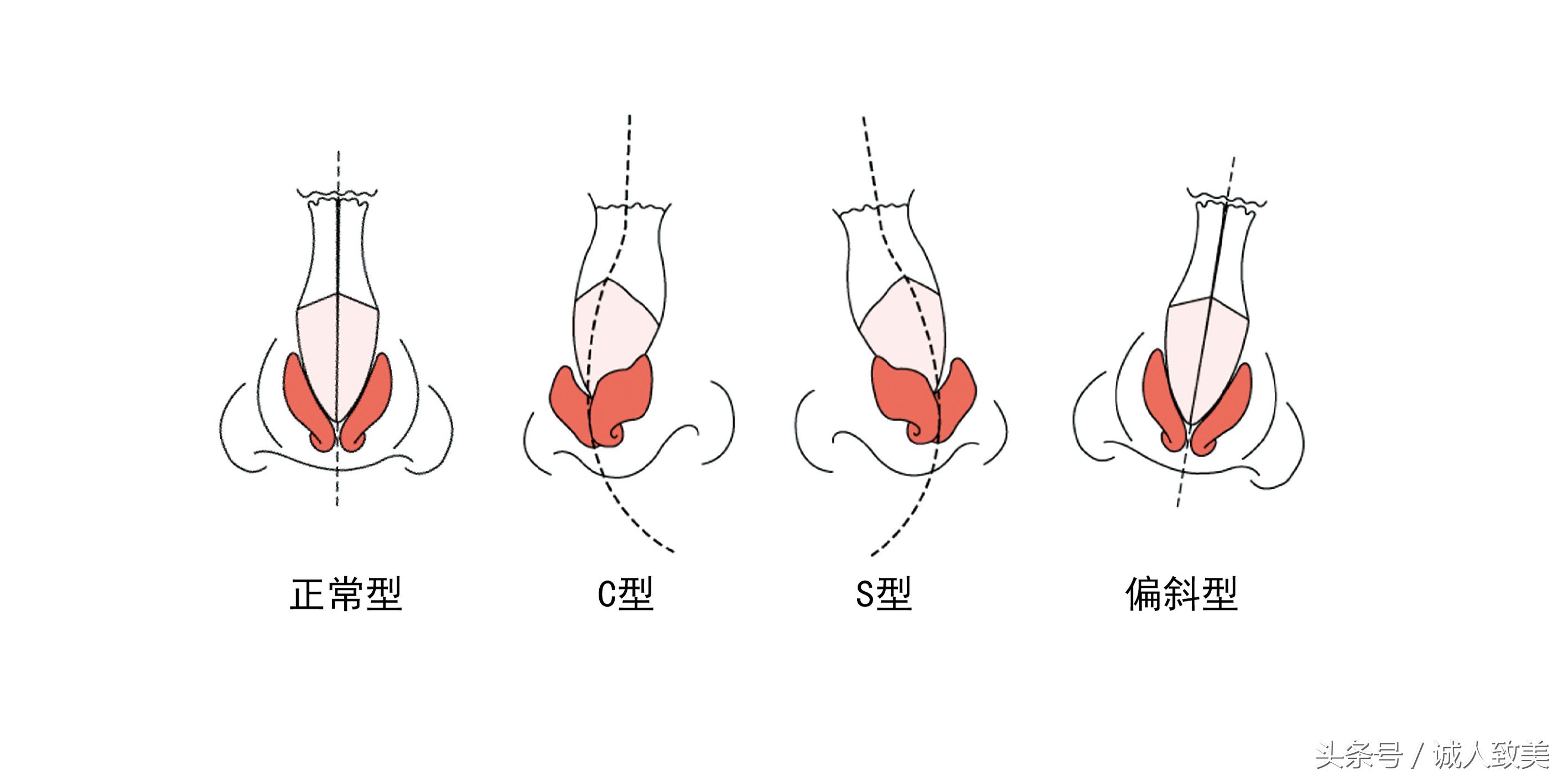 在家如何矫正歪鼻梁,歪鼻梁怎么修容