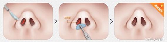 女生怎么逆袭蒜头鼻,女生通天鼻怎么修