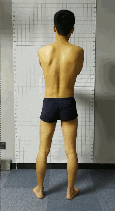 线下矫正案例分析｜体态与步态的关系，粗细腿大小臀是怎么出现的