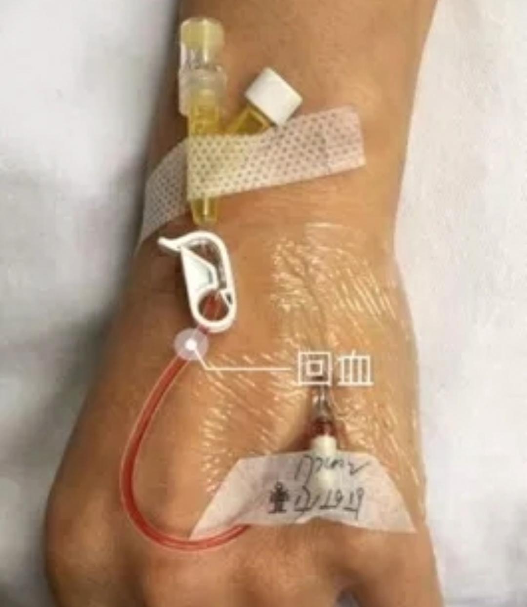 套管针的使用方法和保留方法,怎么让套管针回血