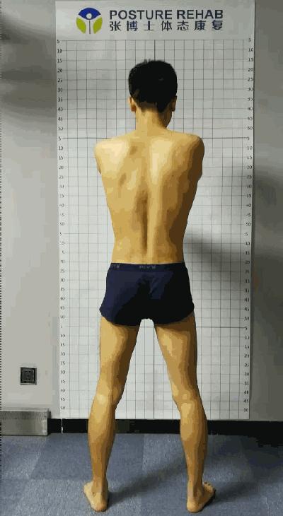 线下矫正案例分析｜体态与步态的关系，粗细腿大小臀是怎么出现的