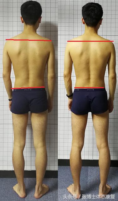 线下矫正案例分析｜体态与步态的关系，粗细腿大小臀是怎么出现的