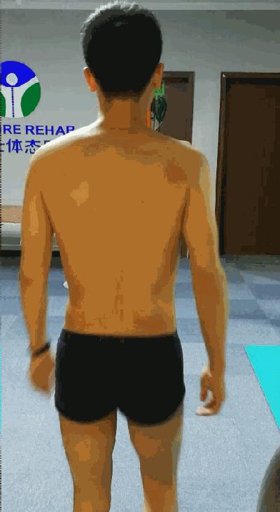 线下矫正案例分析｜体态与步态的关系，粗细腿大小臀是怎么出现的