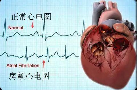 喝酒引起房颤戒酒后恢复吗,喝酒引起的房颤把酒戒了会好吗