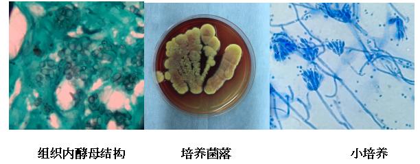 一个病例迸发大聪颖！浙大一院皮肤科与北仑分院皮肤科联合在《新英格兰医学杂志》发表论文