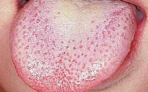 猩红热患儿的护理,猩红热宝宝关注事项